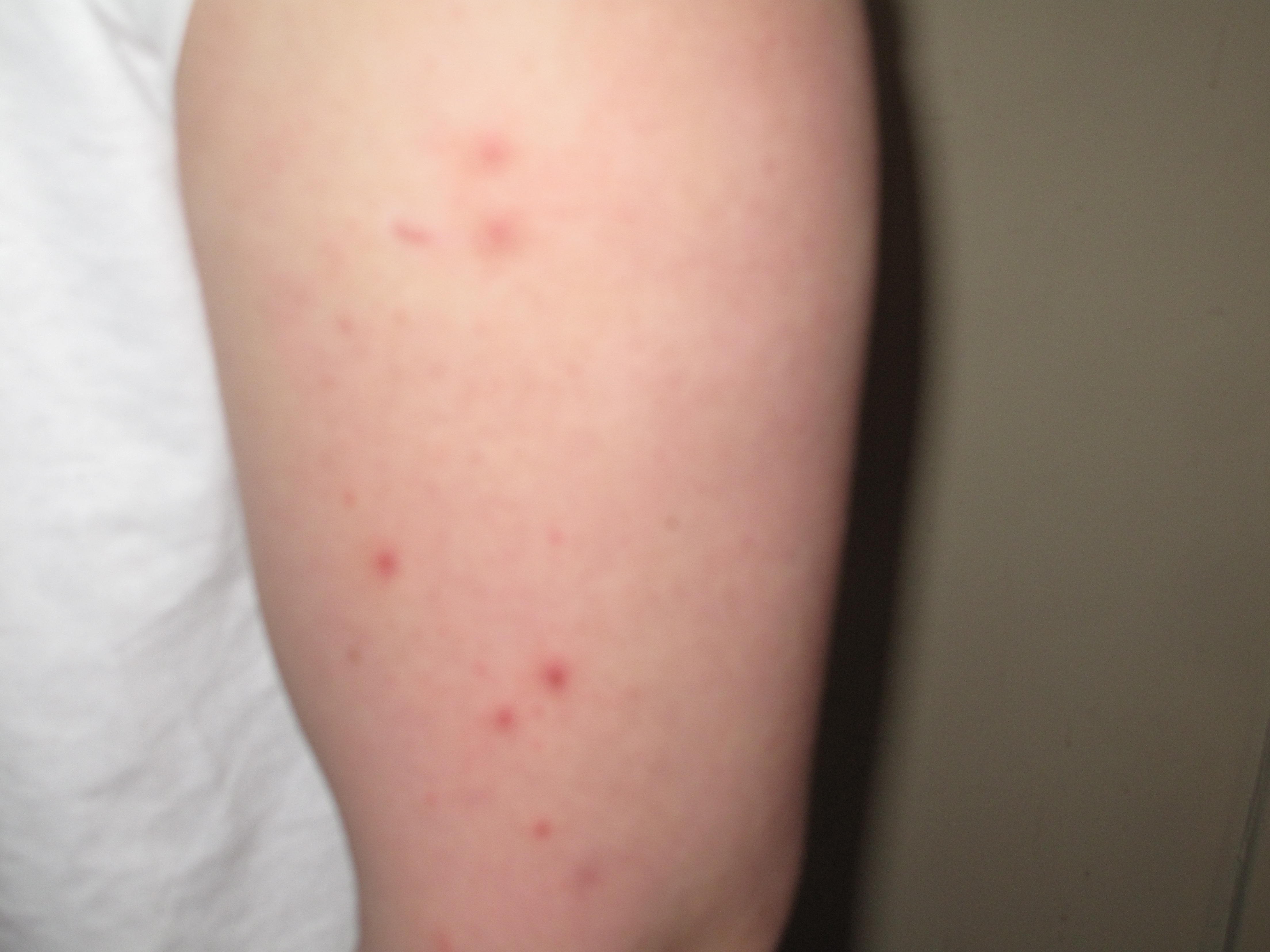 Bed Bug Bite Pictures Extermiman Pest And Wildlife 5098